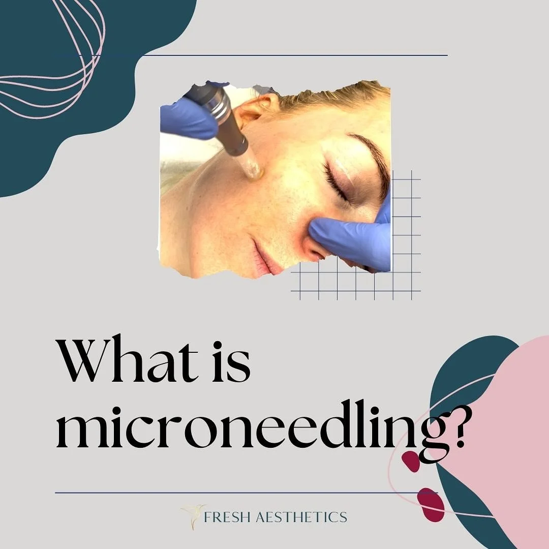 🚀 microneedling aka collagen induction therapy, is a fantastic treatment for the whole face! 

✨  Book yours via link in bio

#microneedling
#collageninductiontherapy #collagenstimulation