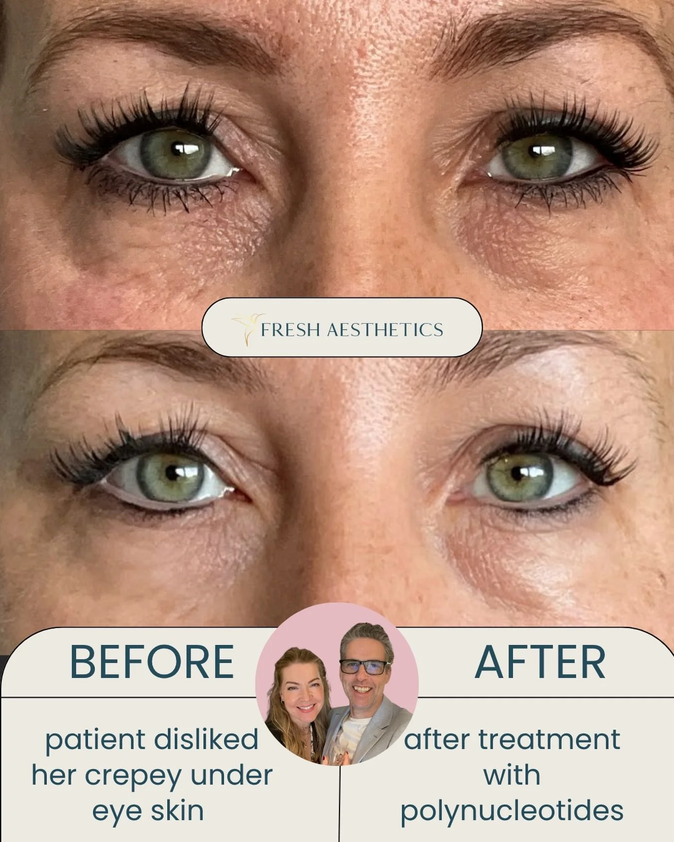 😍 We love polynucleotides for the treatment of delicate eye skin 

🧬Key mechanisms/benefits:

1) Hydration. PNs attract and hold water so they plump the skin 

2) Collagen stimulation. they stimulate fibroblast activity which leads to collagen and 