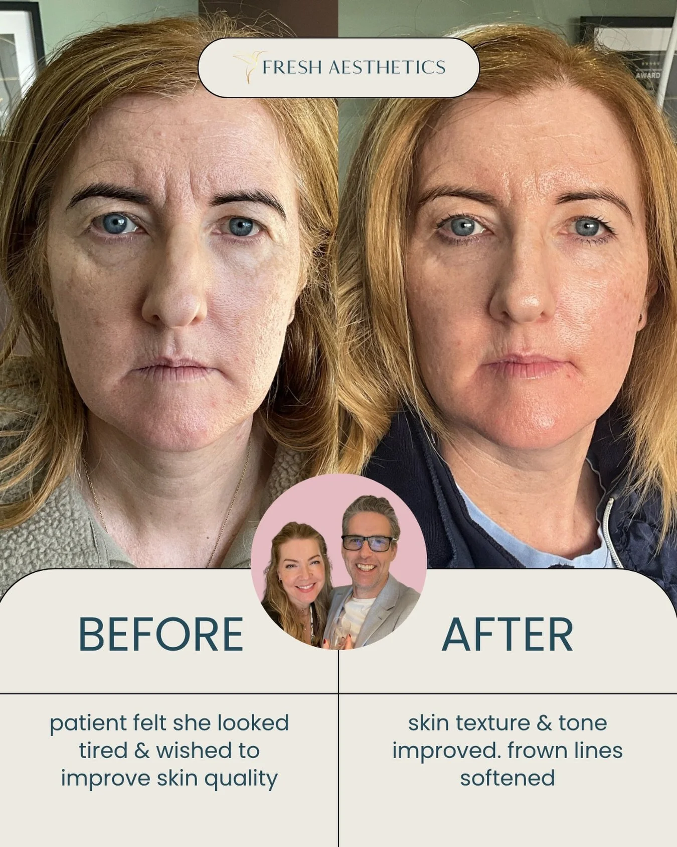 💥The impact when your patient is committed to the process! This Freshen up was achieved over 5 months by consistent use of medical grade skincare, complimented in clinic by a course of microneedling &amp; muscle relaxing to soften frown lines

🤝At 