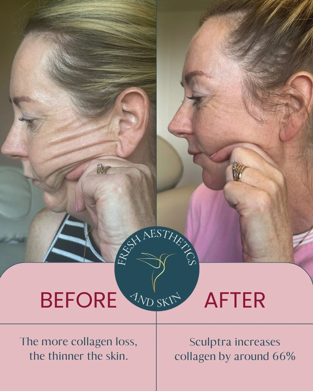 This is why we LOVE Sculptra.

It works gradually with your own skin, stimulating collagen to restore firmness, support and that fresh, healthy look, without making you look different.

Sculptra can increase collagen by around 66% after three months,