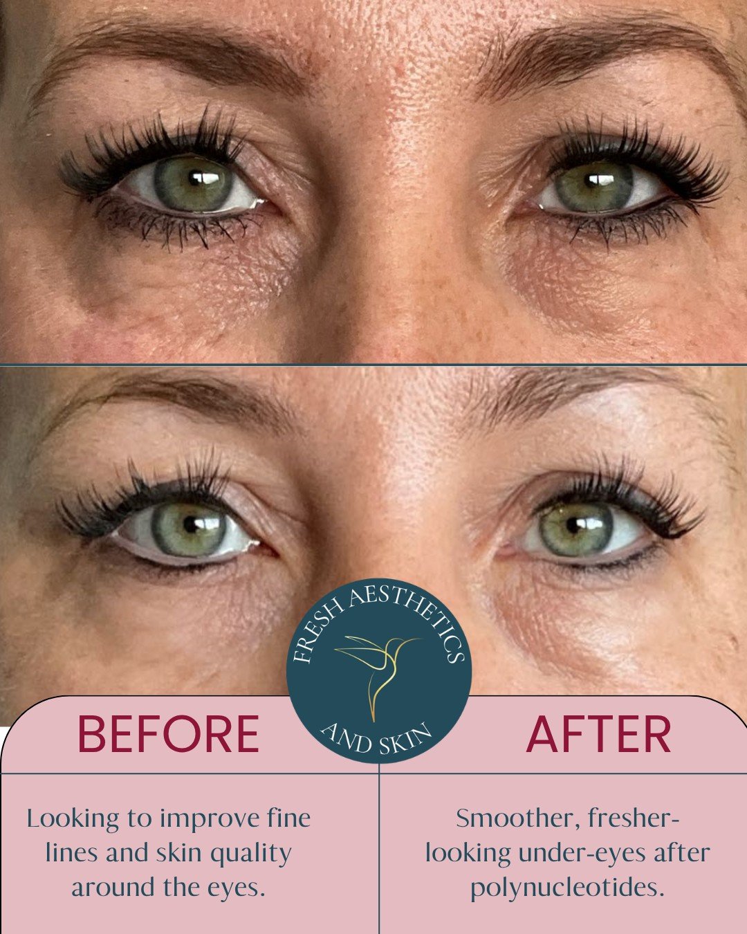This is what improving the quality of the skin, without adding volume or changing your features can look like.

Polynucleotides work with the delicate skin around the eyes, supporting hydration, collagen and natural cell renewal from within.

The res