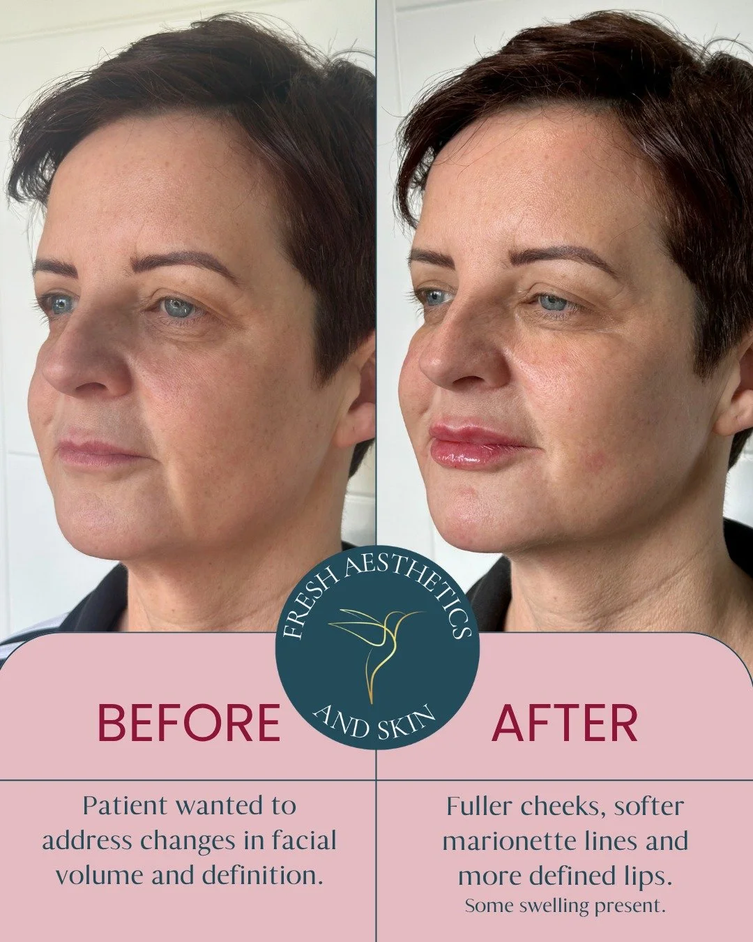 Want to restore a little fullness and definition while keeping what makes you, you?

This dermal filler result shows fuller cheeks, softer marionette lines and more defined lips. Some swelling is present in the after photo.

At Fresh, we look at your