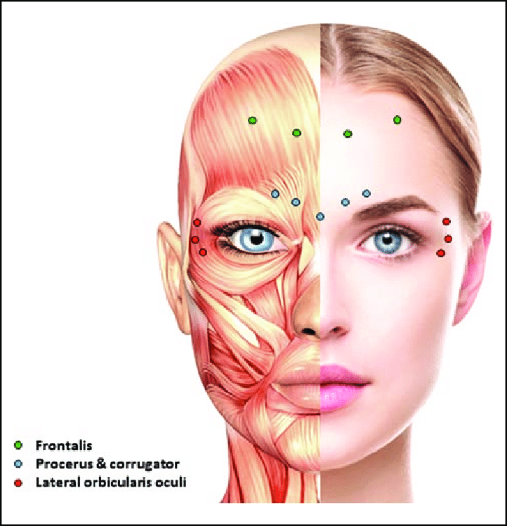 Eye Puff Injection Puffy Eyes After Botox | Causes, Prevention & Expert Advice – Fresh ...