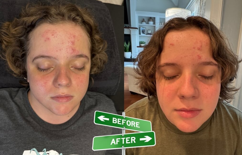 Another acne results-driven facial ⭐️

1 day apart - you can already see less redness &amp; inflammation

High-frequency, skin scrubber, &amp; extractions were the key for this beautiful face🤩

#acnetreatment #facial #esthetics #longisland #northfor