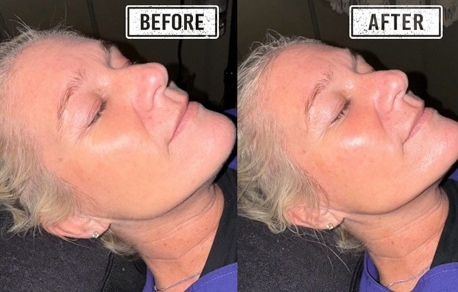 My beautiful aunt came for her first ever dermaplaning facial🤩

Dermaplaning allows for a smoother face complexion, less congestion &amp; skin buildup on your skins surface, easier makeup application, &amp; being &ldquo;peach fuzz&rdquo; free!

****