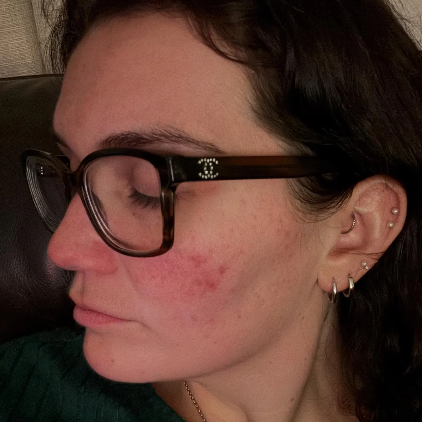 Stress acne is real &amp; many people suffer from breakouts! 

I&rsquo;ve been dealing with these flare ups on my cheeks on and off for some time.. a hormonal imbalance, compromised skin barrier, among other factors can cause these areas to reignite
