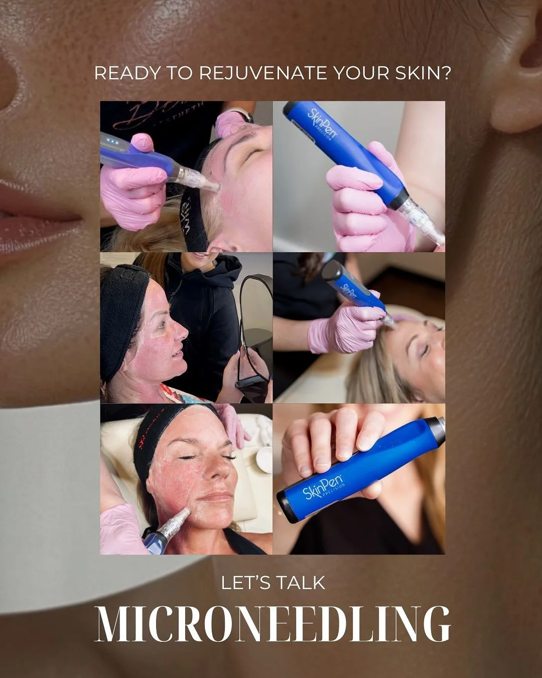 It&rsquo;s true! Smooth, radiant skin is just one Microneedling session away! 👏

Microneedling boosts collagen and elastin to smooth fine lines, reduce acne scars, minimize pores, and even out your skin tone. The result? Soft, radiant, and refreshed
