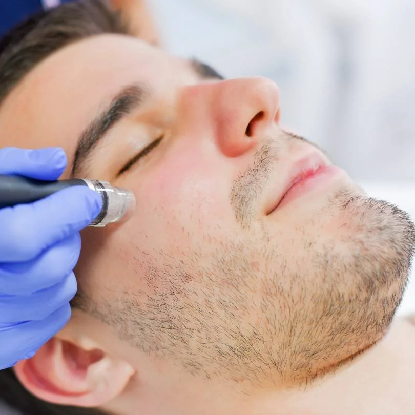 Dr. Jérôme Ruhnau Microneedling Mann.jpg