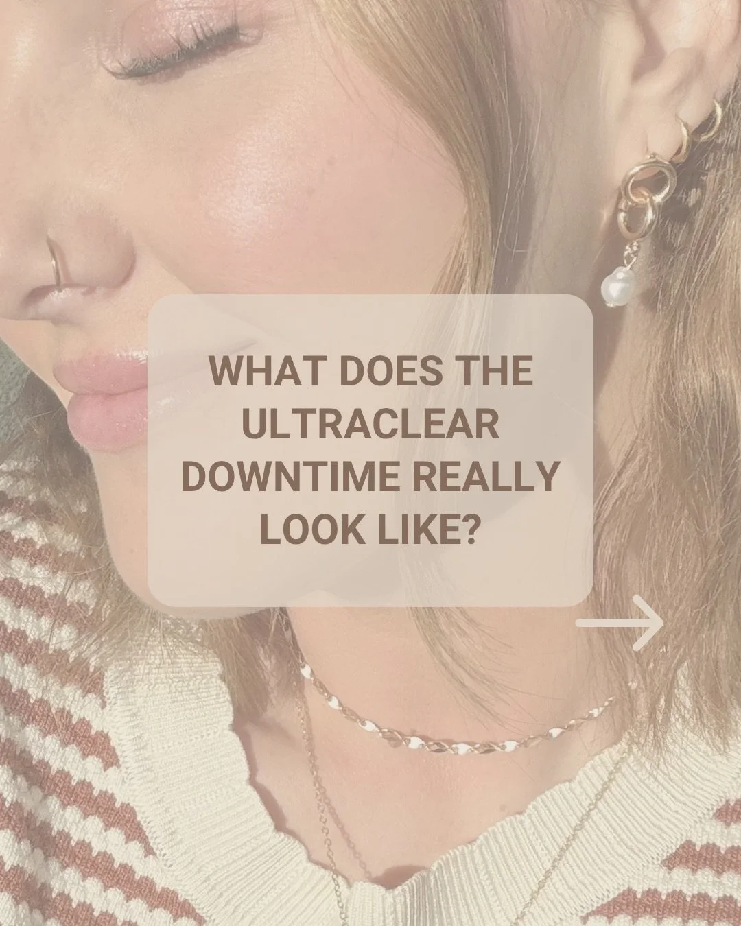 Rachel wanted to focus on a few things a lot of us start noticing around this age &mdash; skin texture, pores, pigmentation, and those fine lines around the eyes and mouth.

These photos show her healing process after UltraClear, along with some real