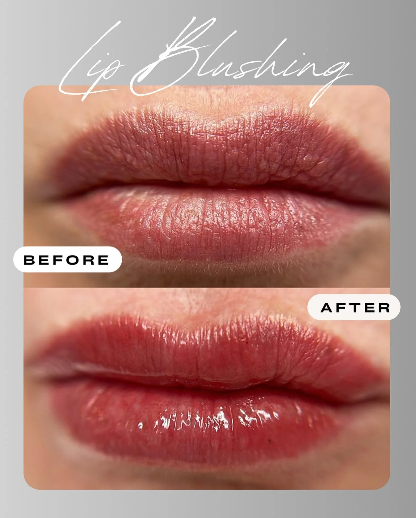 These lips really took the color well after the initial session but I had to refresh the center of the lips which is the most difficult to implant. 💋

🔻 A lip blushing appointment takes about 3 hours total (includes the consult and procedure). 
🔻 