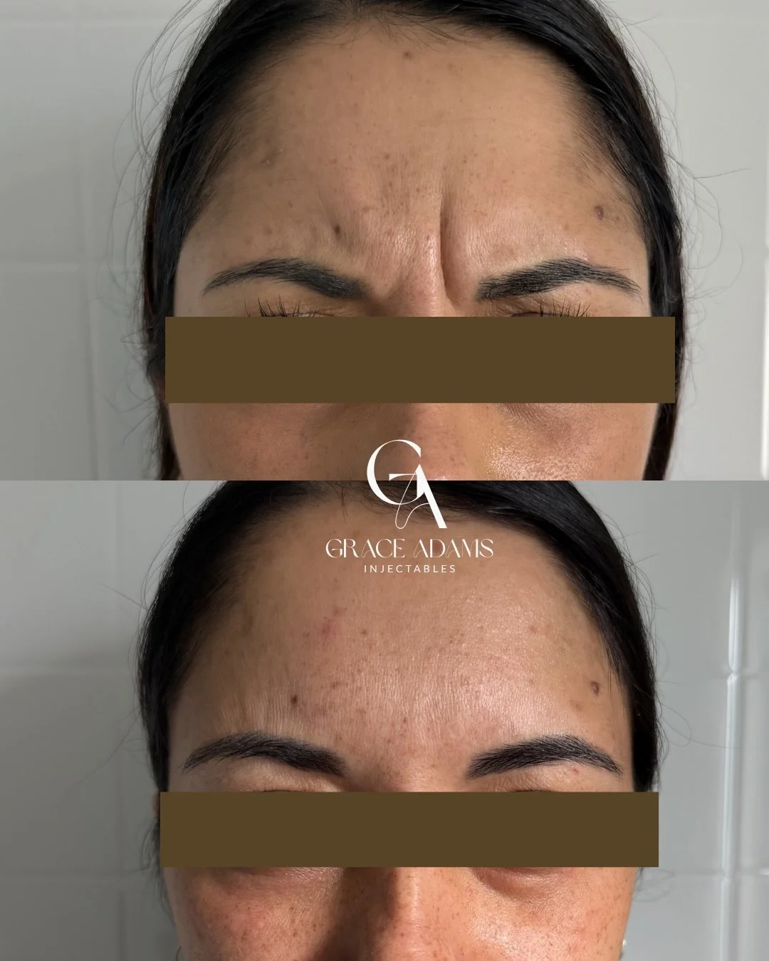 Patient results 6 weeks between photos. 

Here we treated the glabella (frown) and frontalis (forehead) muscles with anti-wrinkle injections. 

Now we are on the next skin health journey with a tailored microneedling plan - with the goal and intentio
