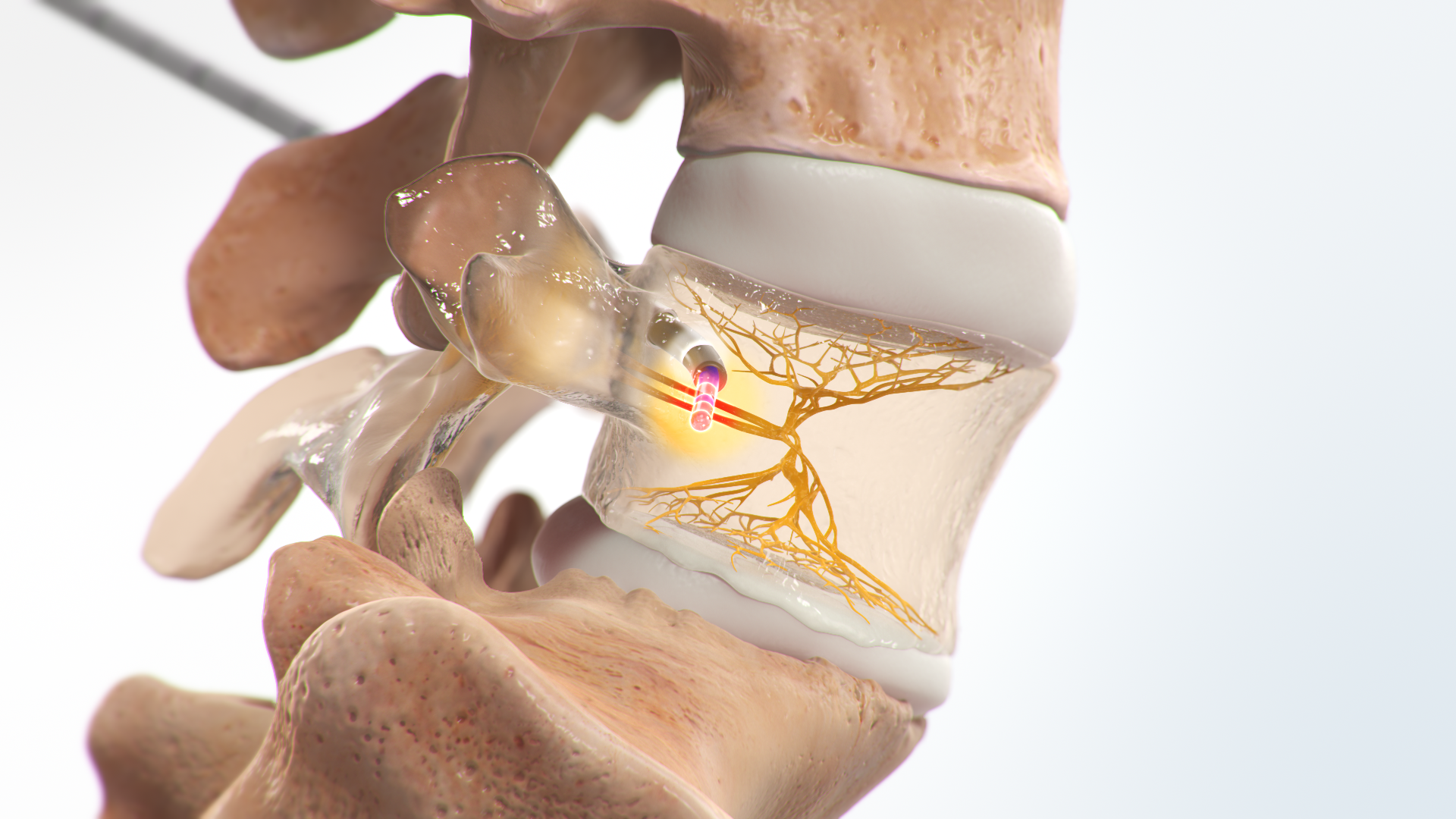 Is the Intracept Procedure Right for Your Chronic Low Back Pain?