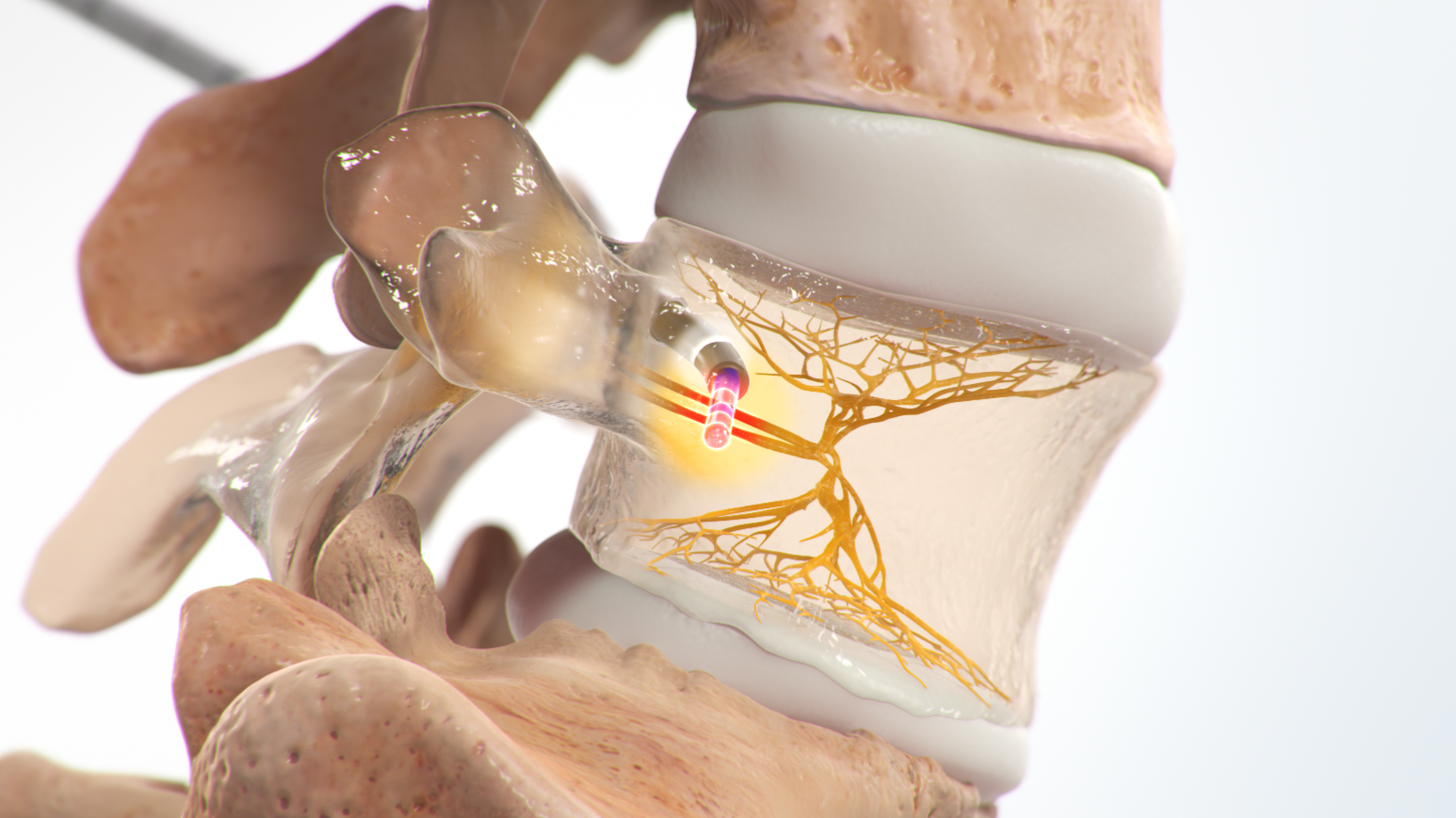 Illustration of the Intracept procedure, with a radiofrequency probe treating the basivertebral nerve inside a vertebra.