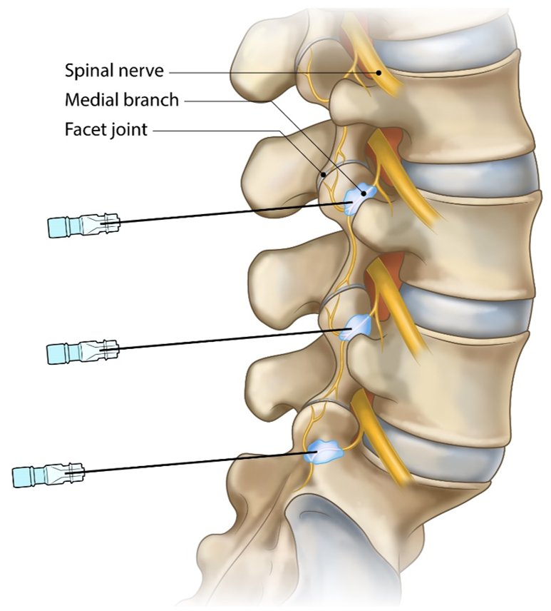 Illustration of a medial branch block placing numbing medication on the nerves that supply the lumbar facet joints