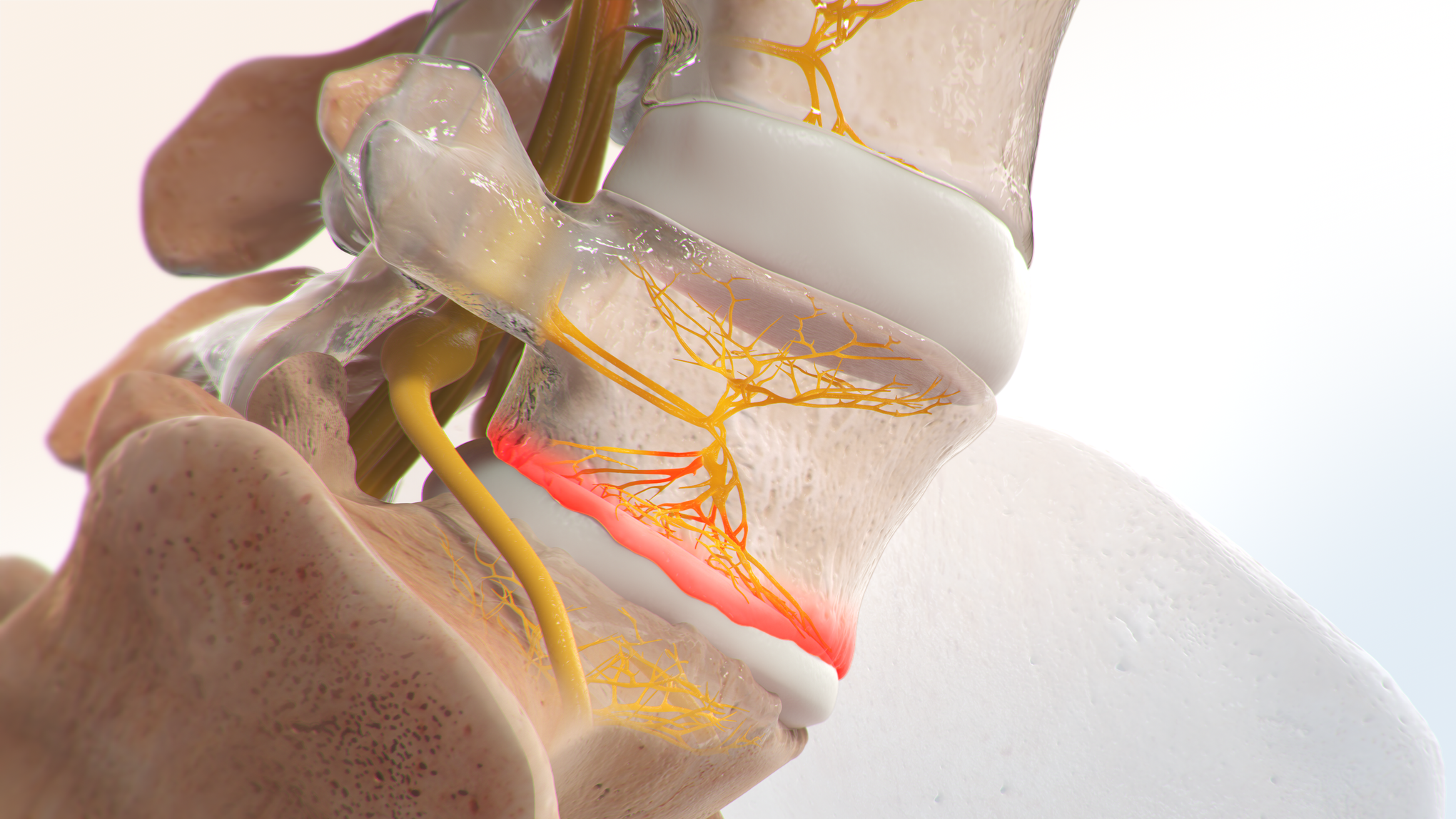 Illustration of the basivertebral nerve carrying pain signals from worn vertebral endplates next to a damaged spinal disc.