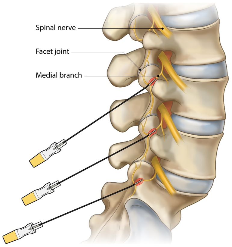 Illustration of radiofrequency ablation treating the medial branch nerves that carry pain from the lumbar facet joints