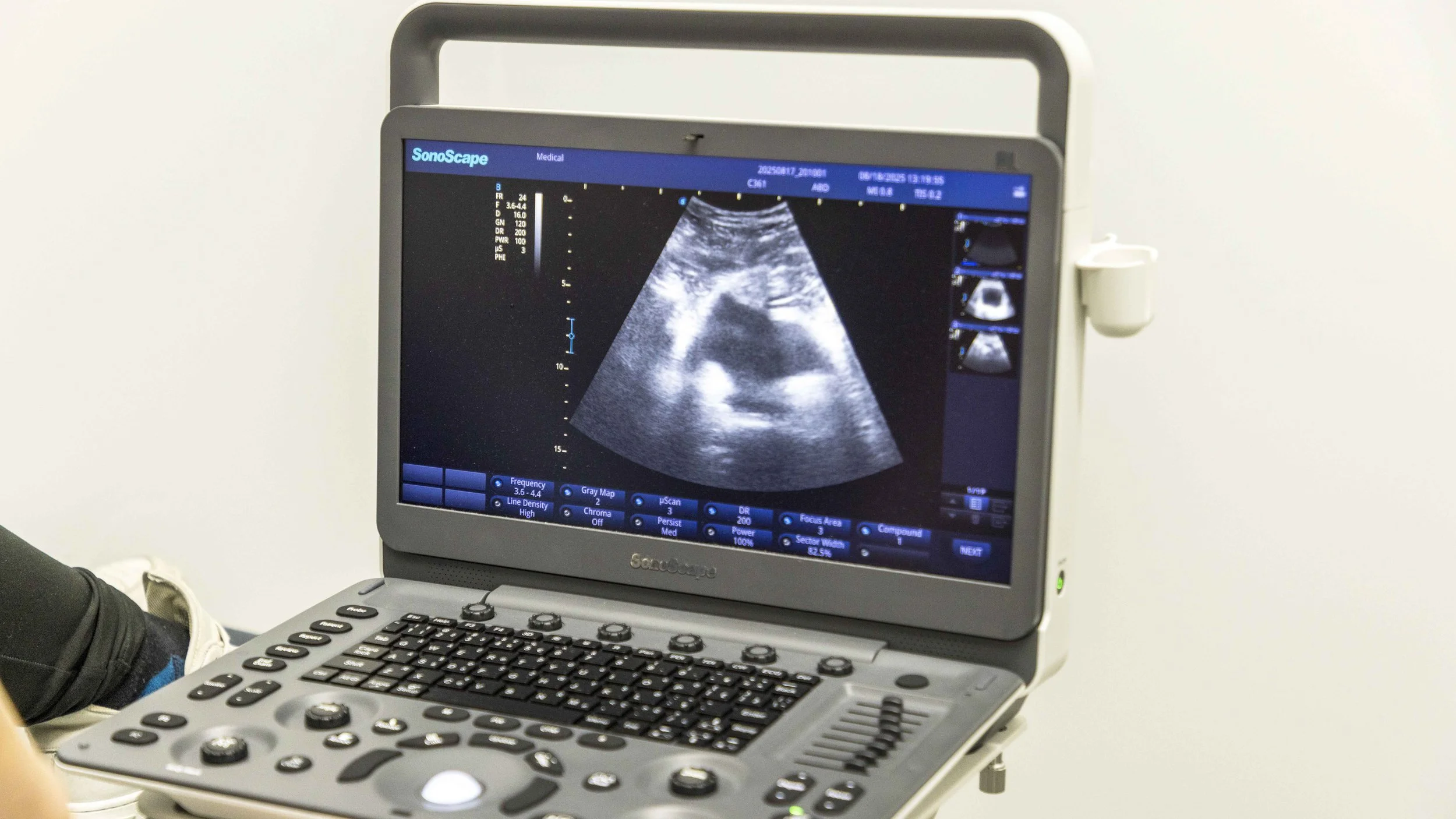 Ultrasound machine displaying a sonogram image of a fetus in the womb.