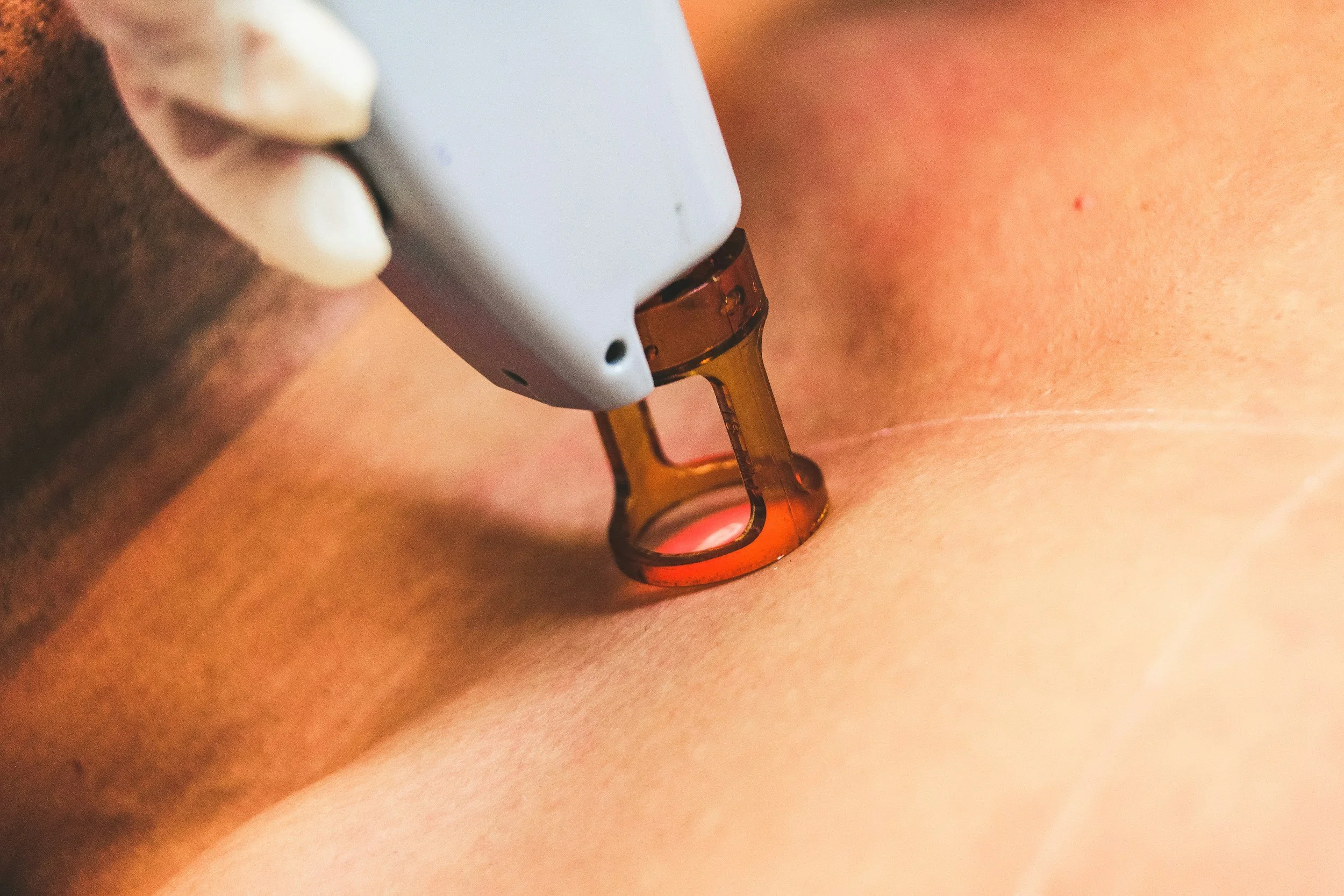 Laser hair removal on skin before and after
