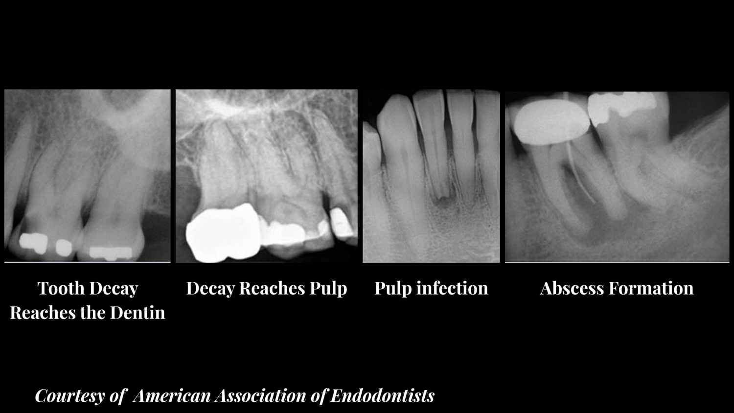 Stage 1 Rct What Happens If You Avoid a Root Canal? | Dentist Explains with X-rays ...