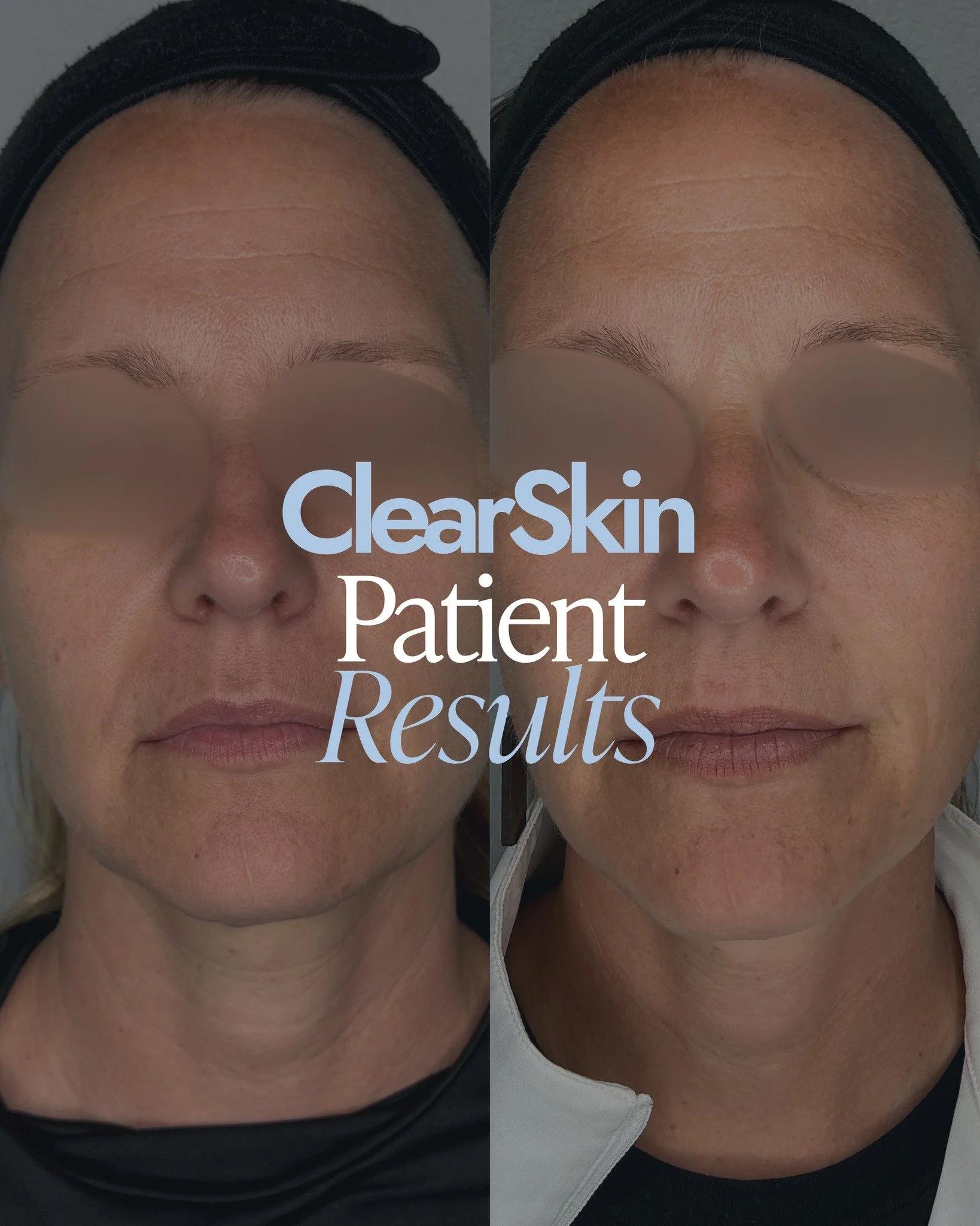 ✨ Real skin. Real results.
These before &amp; after photos show progress after just 4 ClearSkin treatments &mdash; no injectables, no add-ons, just the power of this advanced laser treatment.
ClearSkin works beneath the surface to stimulate collagen,