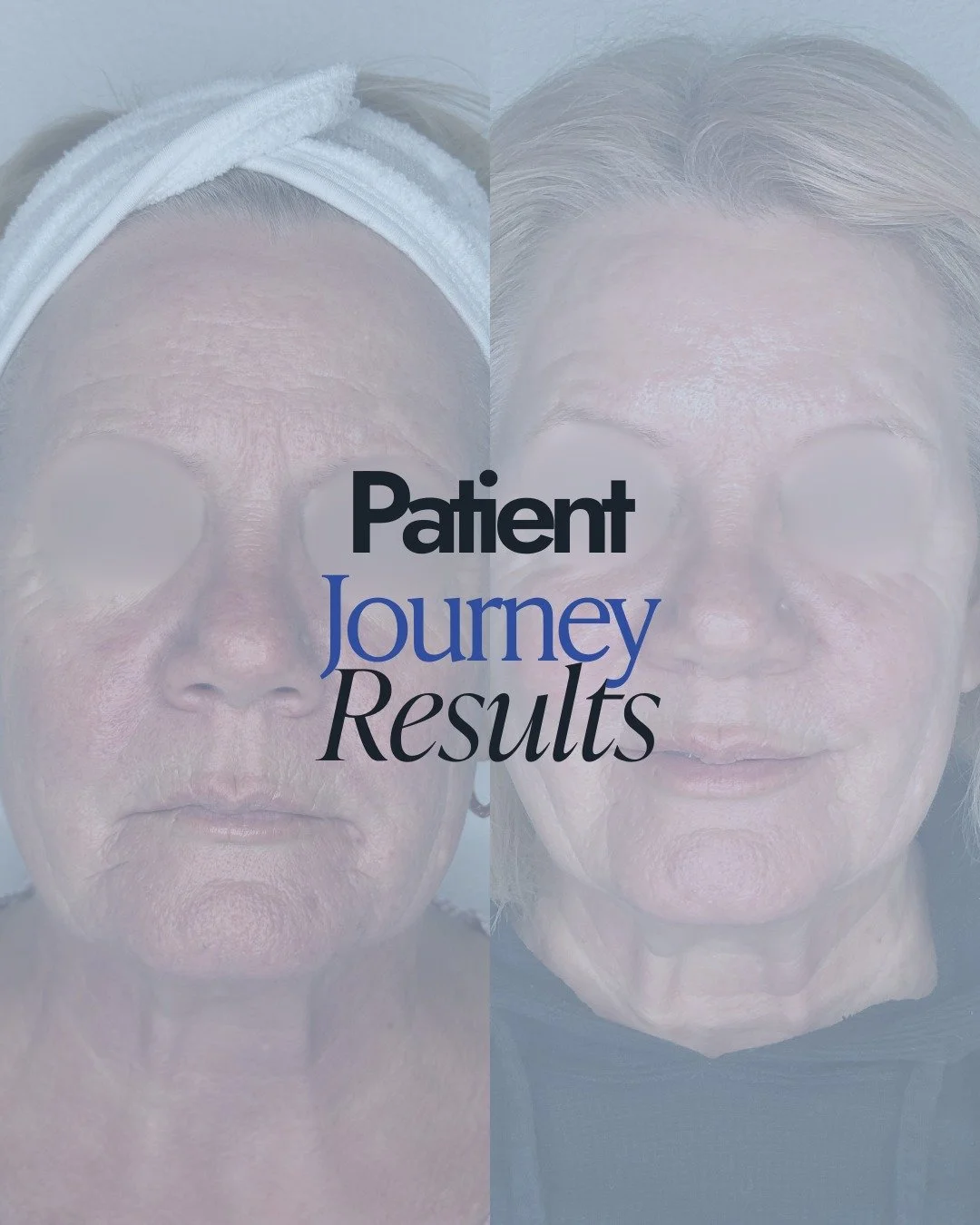 This patient&rsquo;s results highlight what&rsquo;s possible when we take a thoughtful, multi-modal approach.

Redness can be a sign of sensitivity or a compromised skin barrier, so we began by calming inflammation and rebuilding strength. Once her s