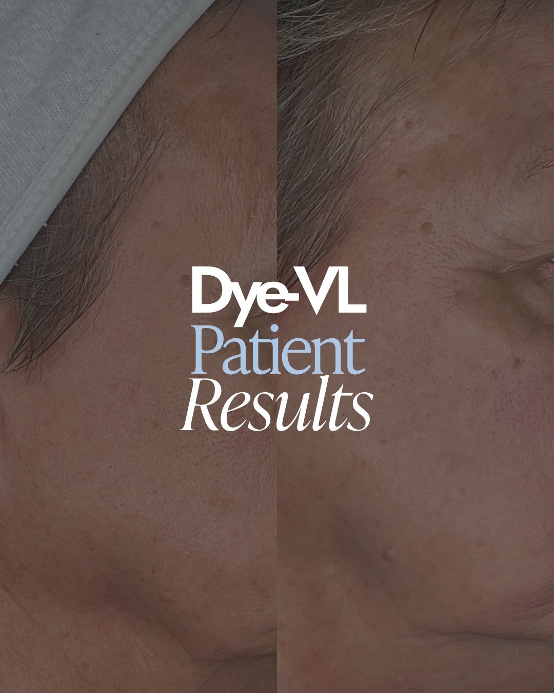 Just one month after a single treatment, her skin looks clearer, calmer, and more even toned. 🌟

With DyeVL and VascuPen, we&rsquo;re able to target unwanted red and brown tones while reducing visible vascularity, improving overall tone, and minimiz