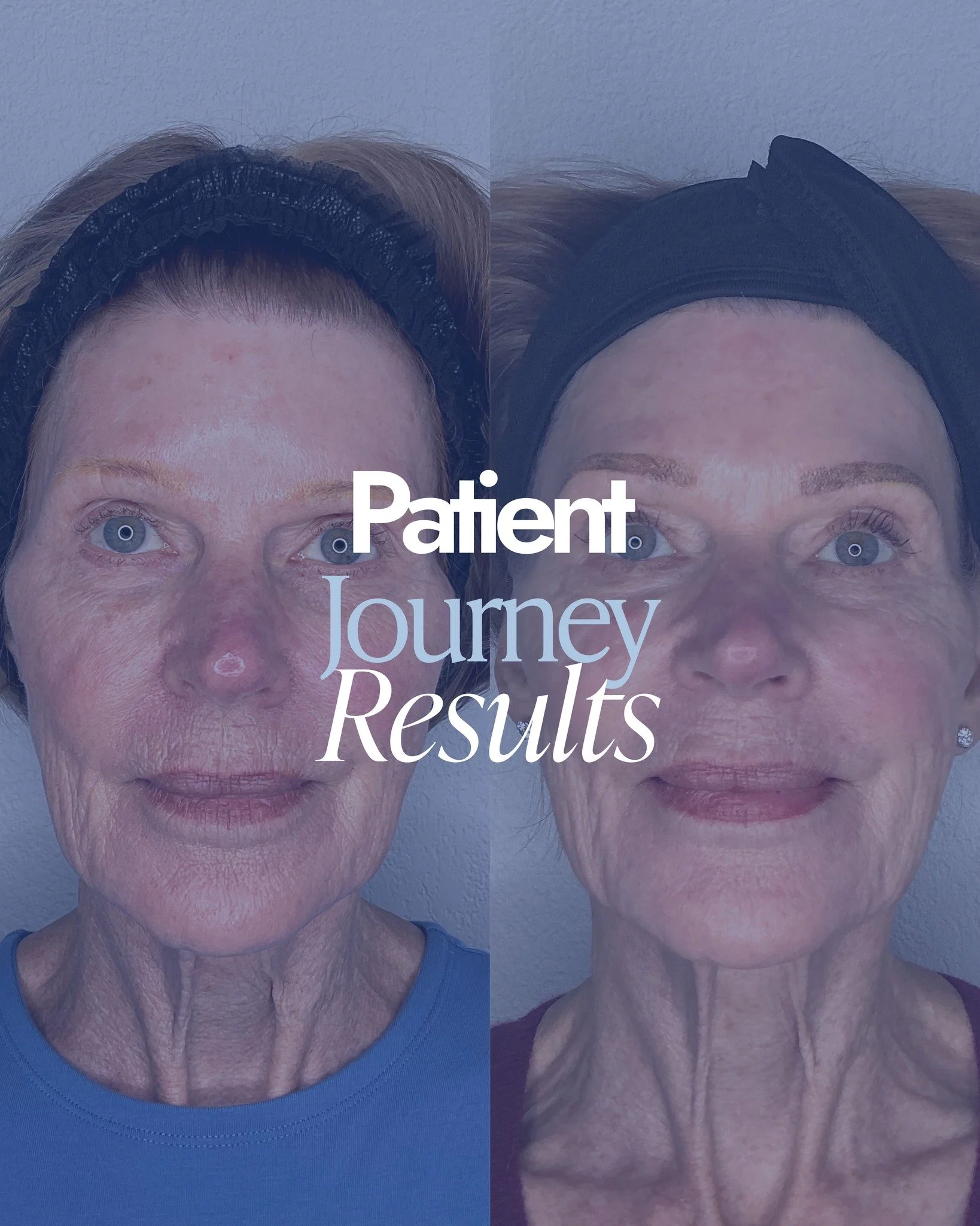 Before &amp; After ✨

A reminder that confidence is built one step at a time &mdash; and results come from consistency, personalization, and expert care.

We&rsquo;re so proud of this patient&rsquo;s journey and honored to be part of it. 💛

Ready to