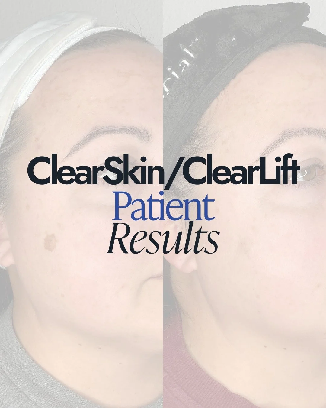 ✨ Progress after just one customized treatment

Using a personalized combination approach:
▫️ ClearLift on the forehead to target melasma
▫️ ClearSkin for overall tone and clarity
▫️ 532 spot treatment for targeted pigment

Thoughtful treatment plann