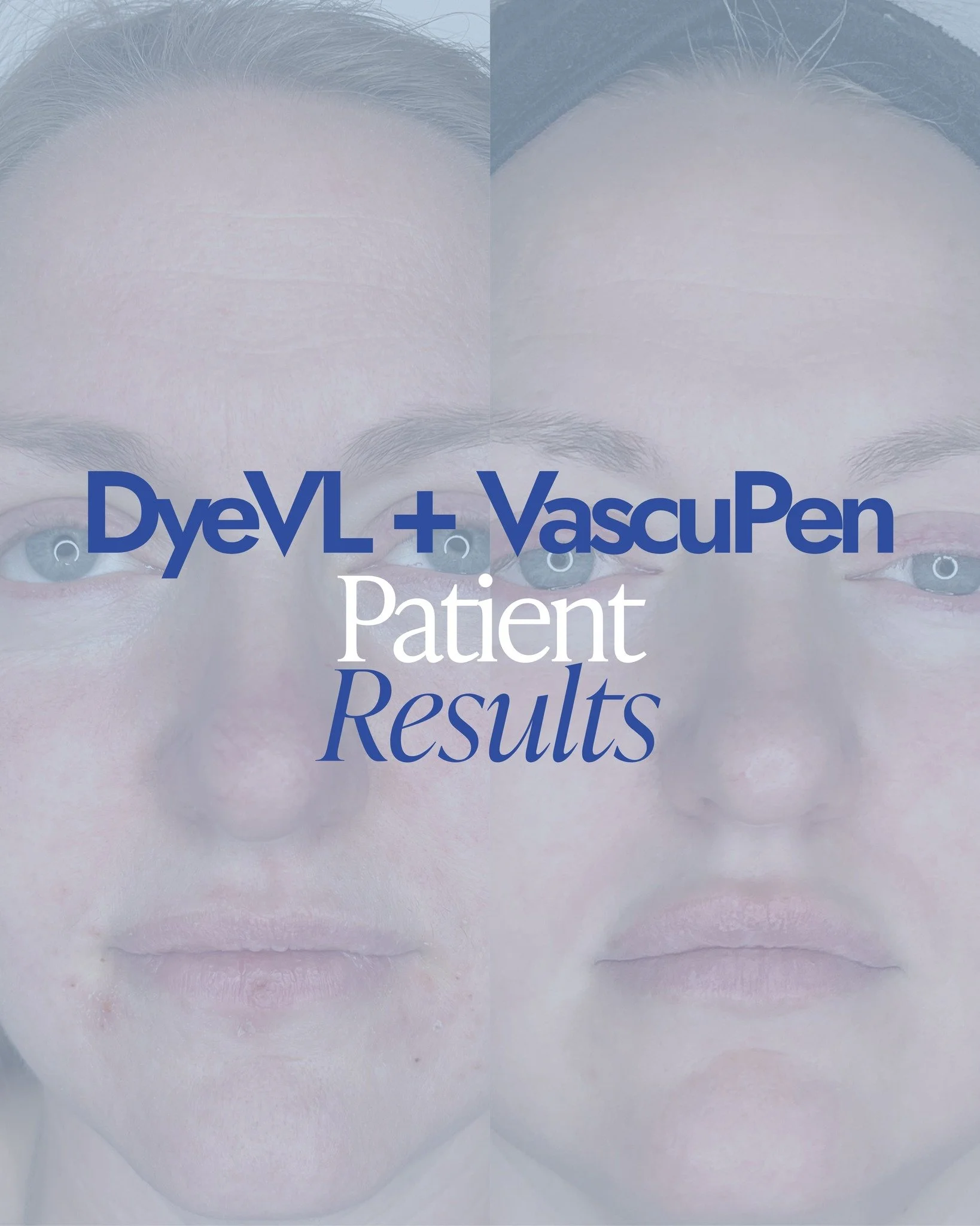 Redness doesn&rsquo;t have to be your normal.

IPL (Intense Pulsed Light) is designed to gently target visible vessels and excess pigment that create that flushed, uneven look &mdash; helping your skin appear calmer, clearer, and more balanced over t