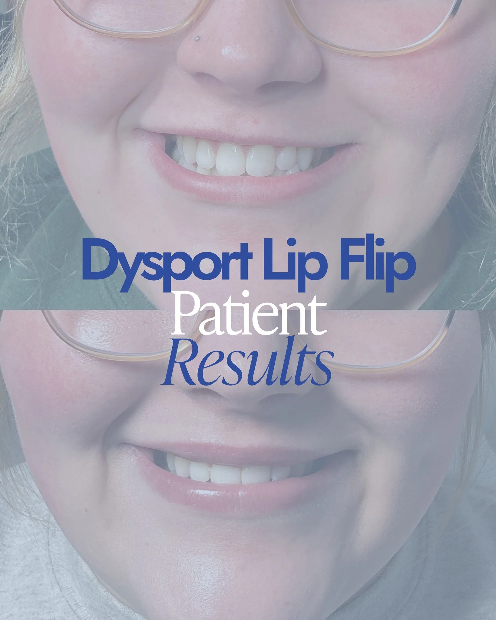 A subtle change&hellip; that makes a noticeable difference 👀

These photos show the impact of a lip flip with Dysport &mdash; creating the appearance of a fuller upper lip without adding volume.

It&rsquo;s all about enhancing what&rsquo;s already t
