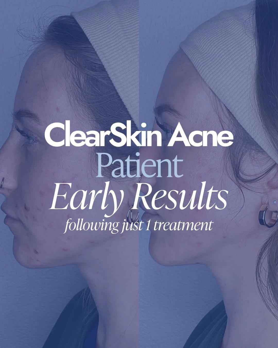 One treatment. Visible progress. 👏

These photos highlight the powerful effects of our ClearSkin Acne treatment after just ONE session &mdash; helping calm breakouts and support clearer, healthier-looking skin.

Consistency builds results, and this 