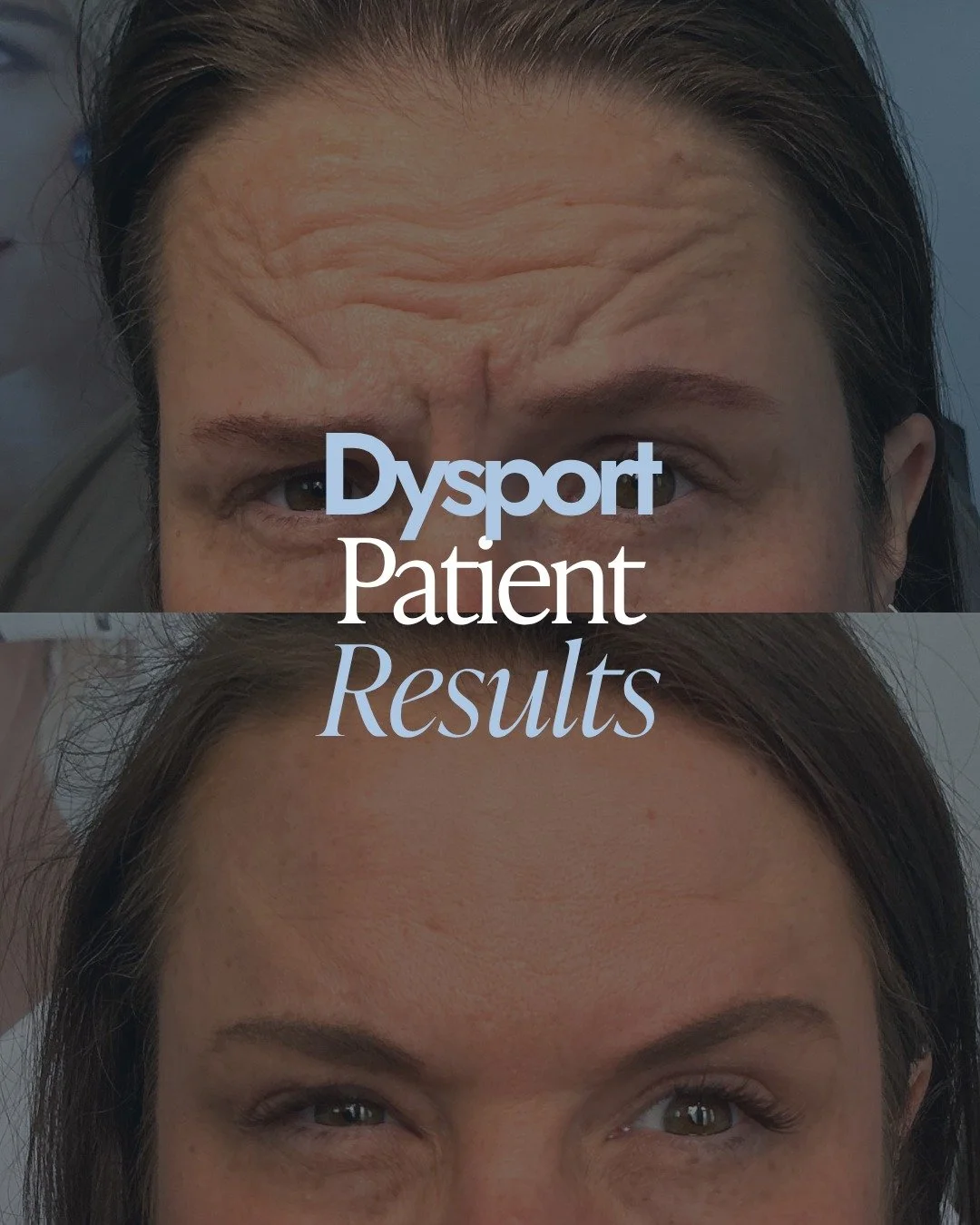 "I finally feel like I look as refreshed as I actually feel.&rdquo; ✨

There&rsquo;s something powerful about looking in the mirror and seeing the same energy you carry inside.

At Essence Aesthetics and Health, Dysport is one way we help bridge