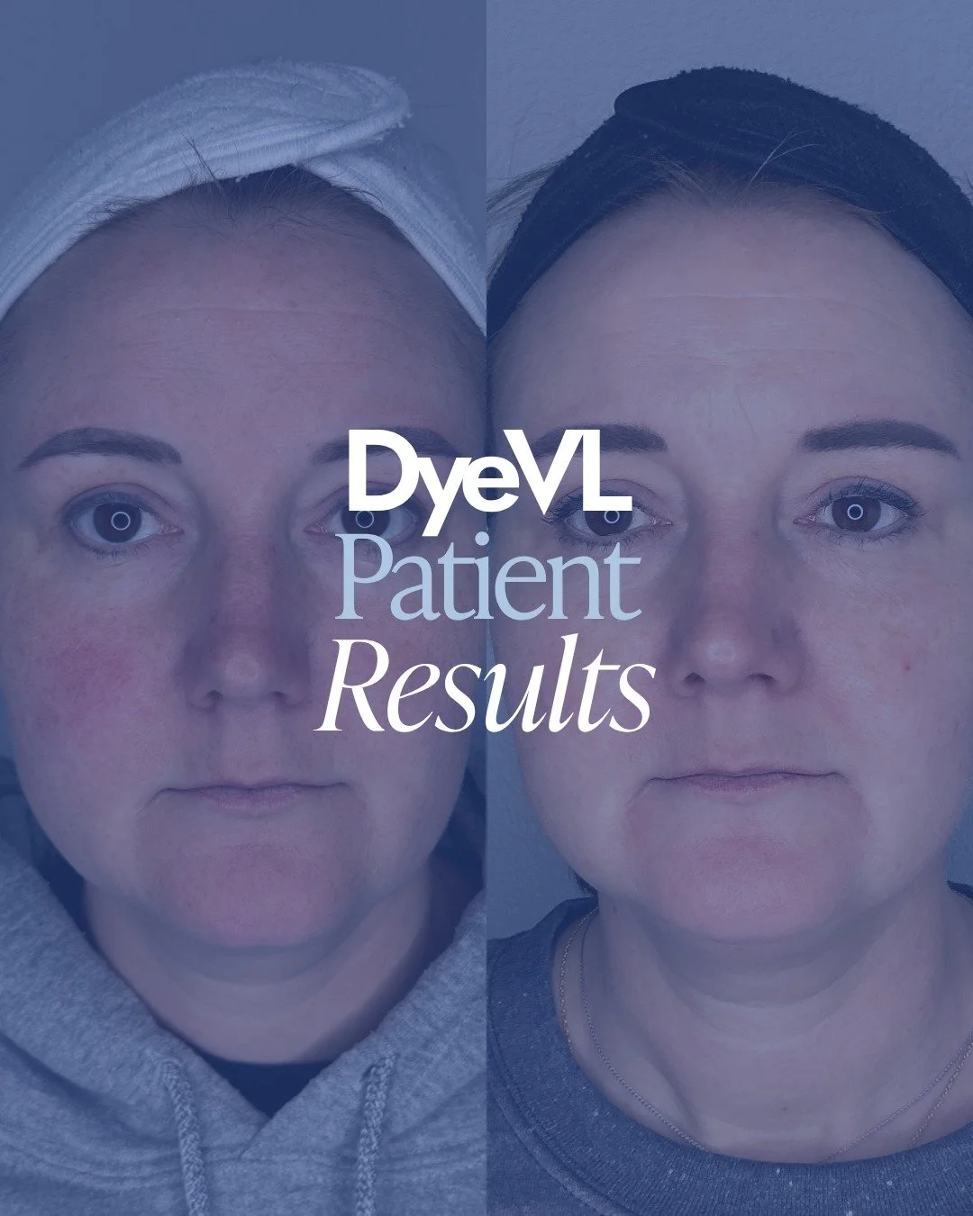 "I didn&rsquo;t realize how much that discoloration was bothering me&hellip; until it was gone.&rdquo; ✨

Sometimes it&rsquo;s not about dramatic change&mdash;it&rsquo;s about a more even, refreshed look that just feels right.
These DyeVL result