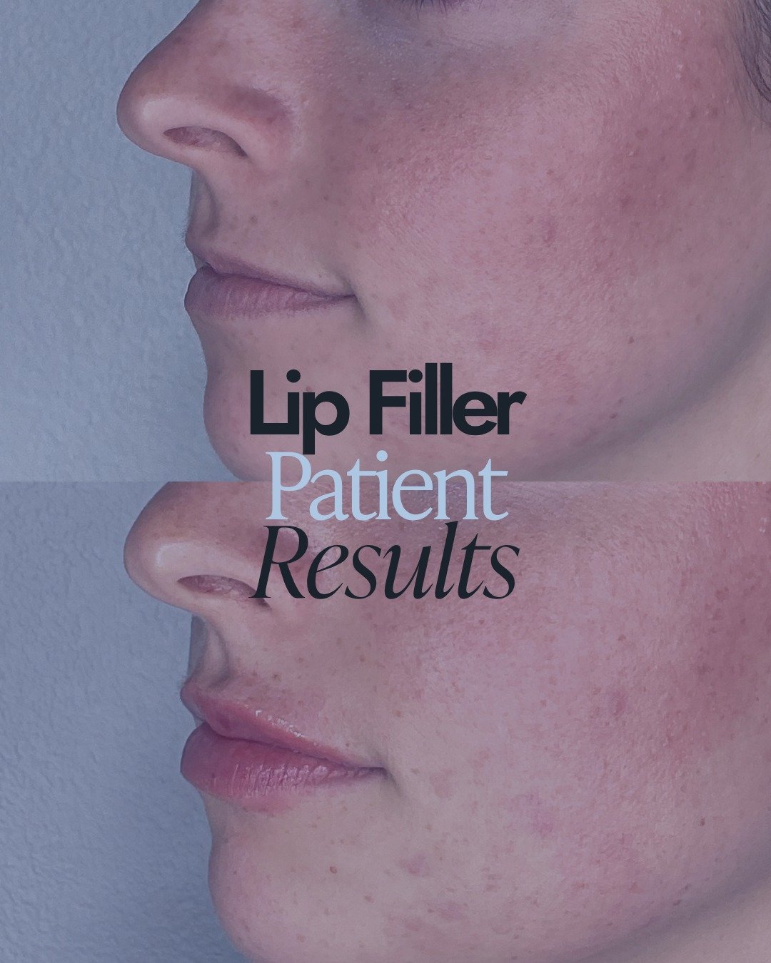 Subtle. Natural. Harmonizing. 👄

That's the appraoch we take to lip filler at Essence &mdash; working with what's already there rather than creating something different. 

What that means:
✦ Volume that looks like yours &mdash; just more defined and