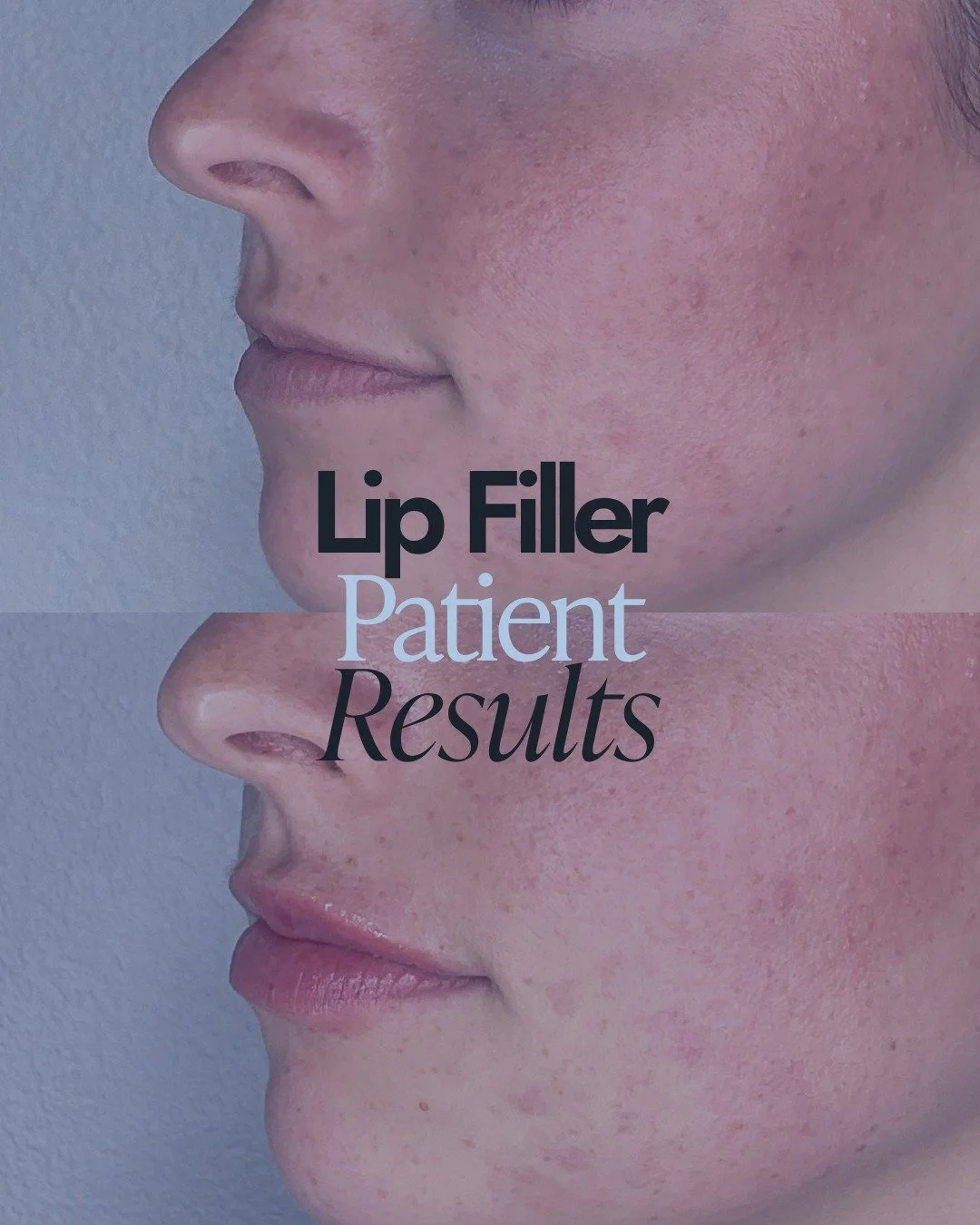 Subtle. Natural. Harmonizing. 👄

That's the appraoch we take to lip filler at Essence &mdash; working with what's already there rather than creating something different. 

What that means:
✦ Volume that looks like yours &mdash; just more defined and