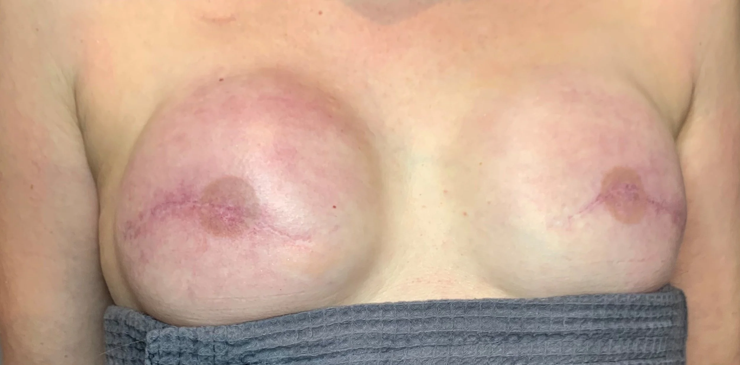 Before Treatment (faded tattoos, not my work)