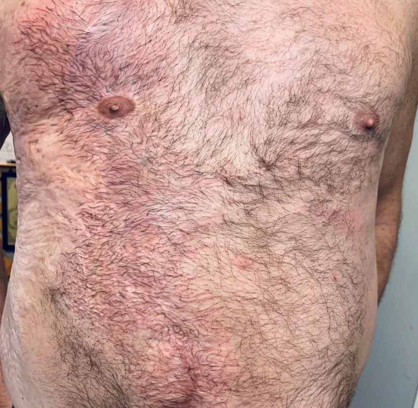 Healed Results + Hair Illusion