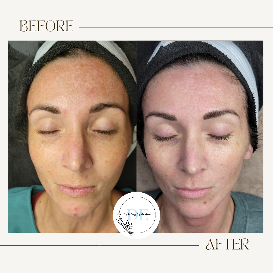 Series of chemical peels and Microneedling