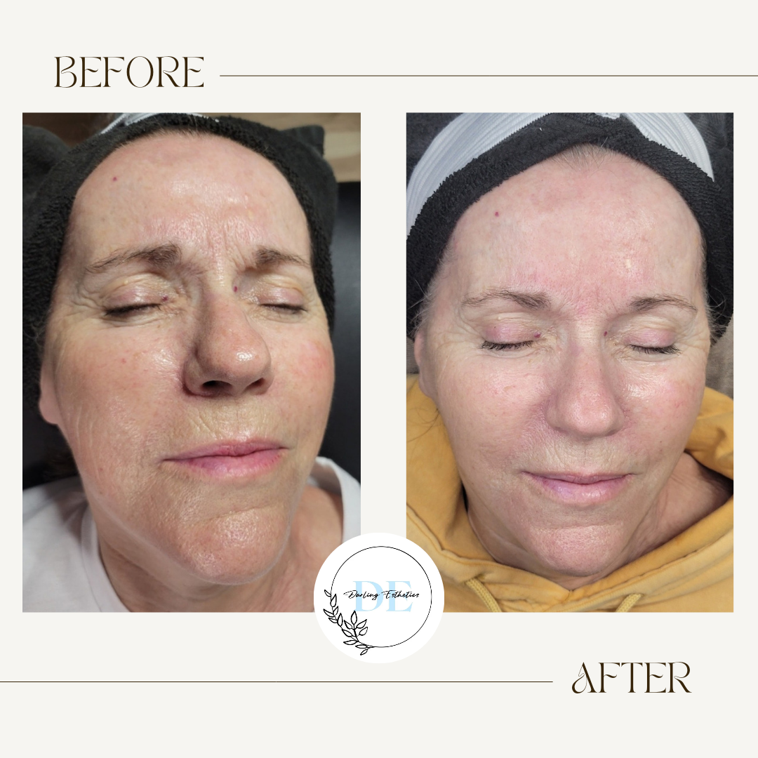 Series of Microneedling