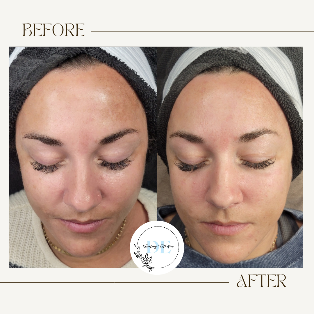 Chemical Peel Series