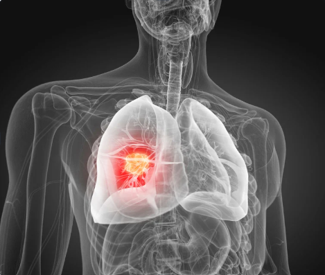 Lung cancer in Germany: incidence and survival trends from ZfKD registry data (2020-2023)