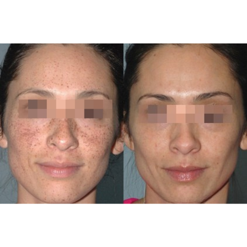 Lumecca IPL Facial Before and After Result