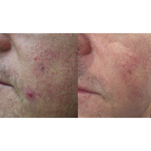 Lumecca IPL Facial Before and After Result