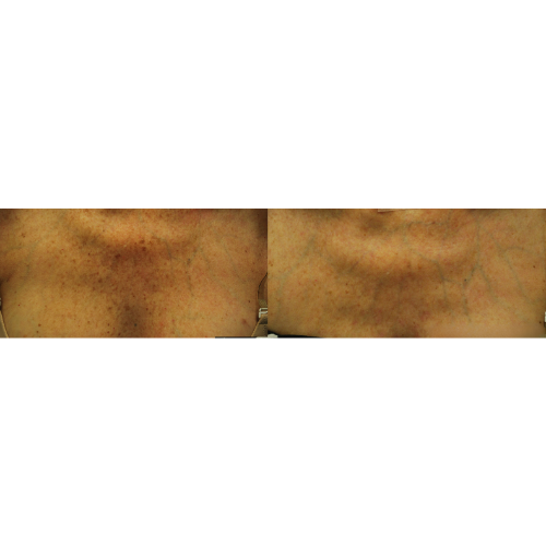 Lumecca IPL Facial Before and After Result