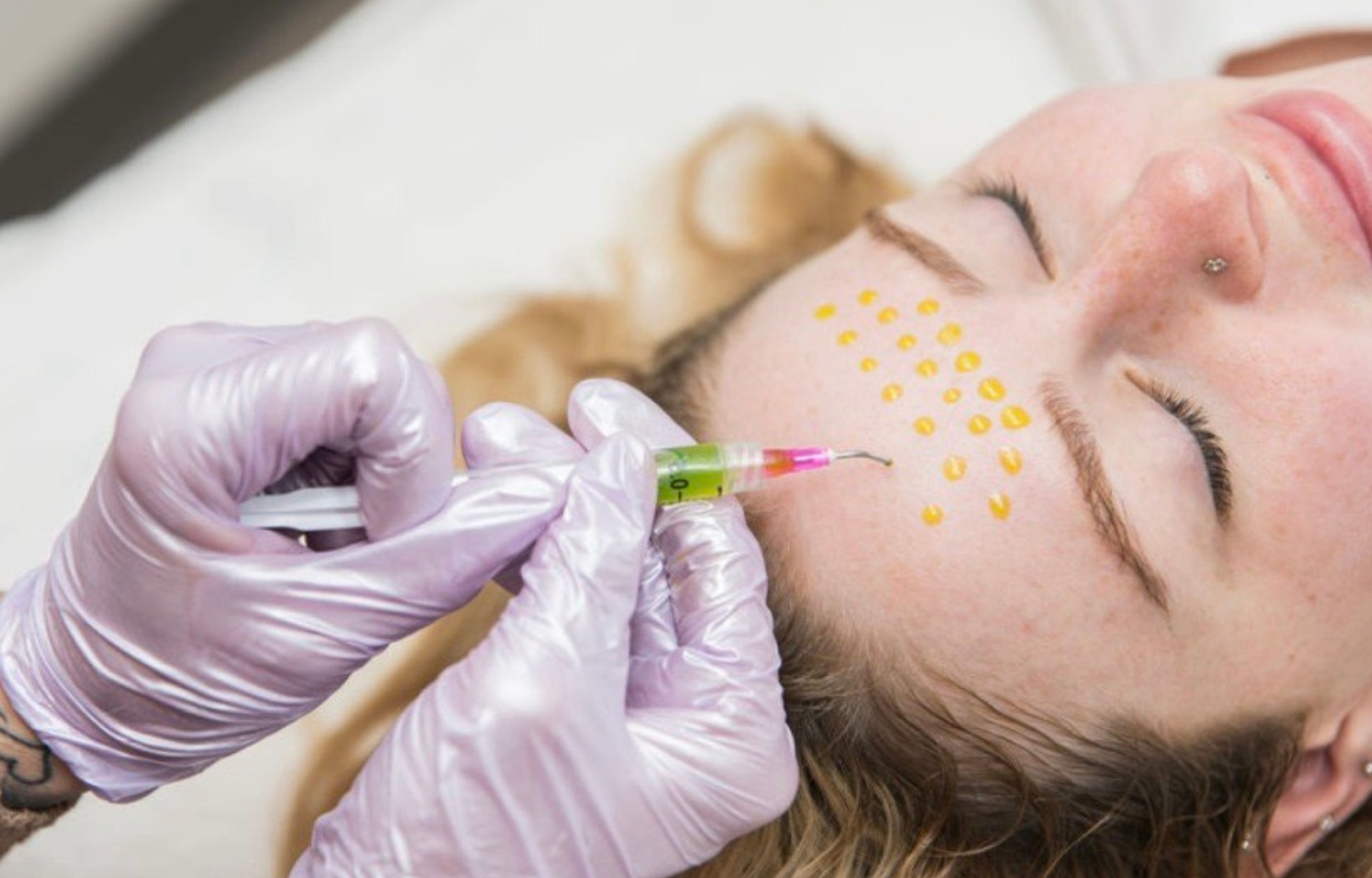 Peels Are Medicine for Your Skin: Healing from the Inside Out