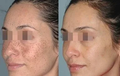 MT_Lumecca_1a_580nm_ShortPulse_StrongCooling_DermaPop_2Intersectingpasses_17J1 (1).jpg