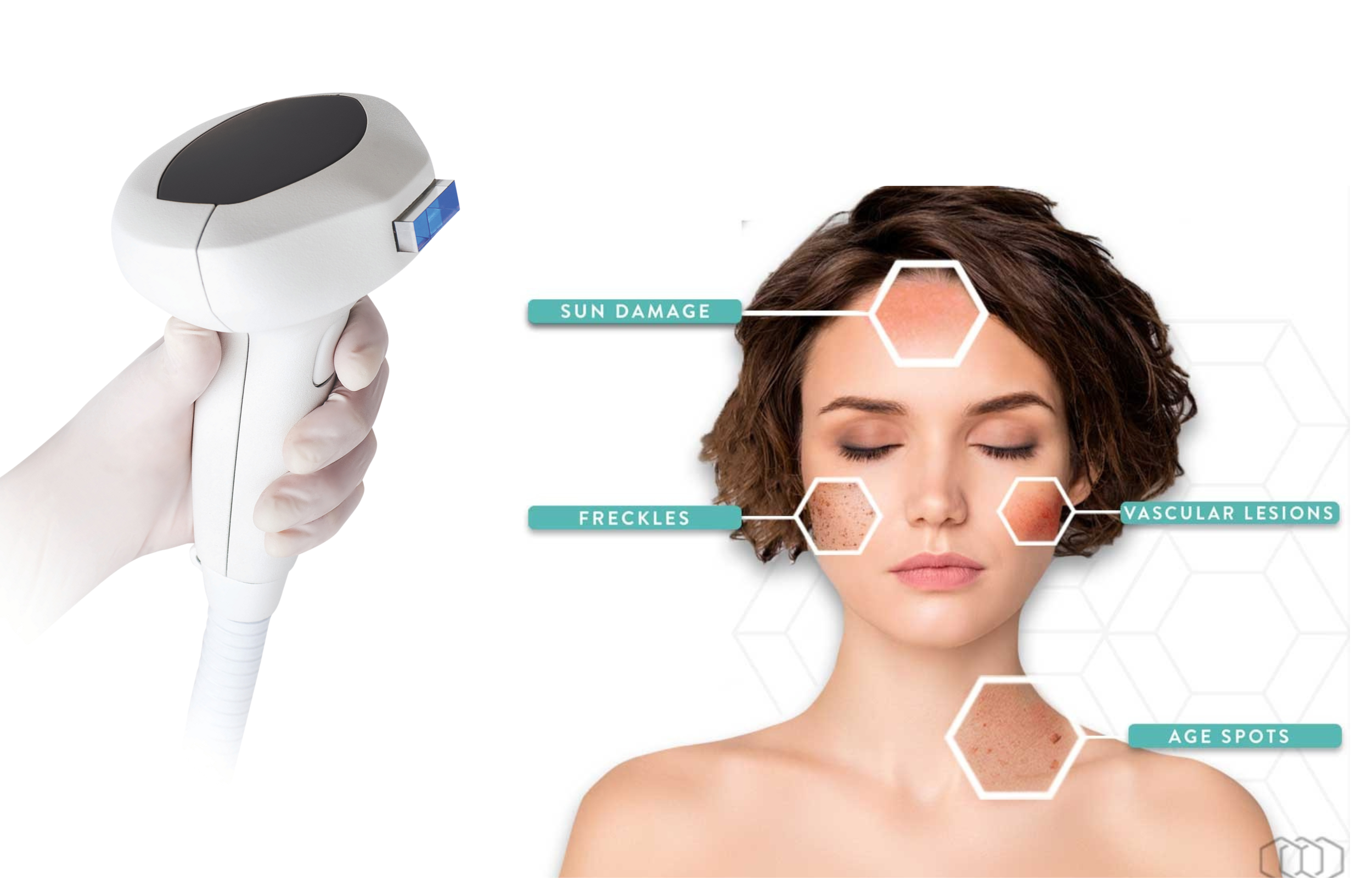 What Can an IPL Photofacial Truly Treat? Targeting Age Spots, Redness, and Beyond