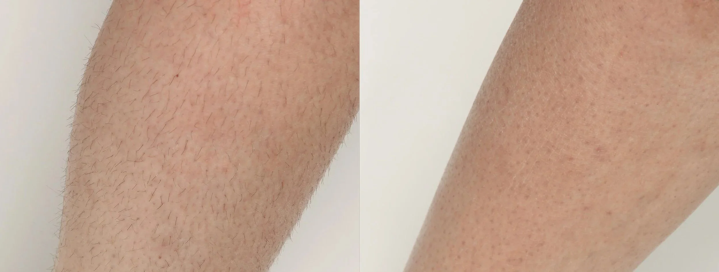 Diolaze_2a_2tx_2months_1st-and-2nd_30J_strongcooling_shortpulse.jpg