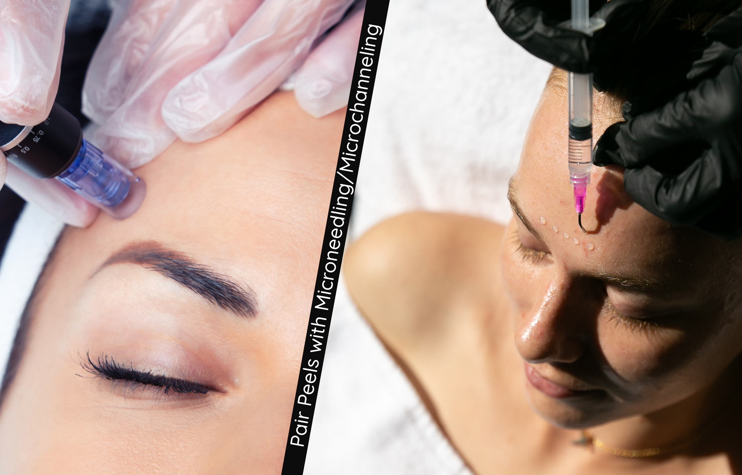 Double the Results: How to Pair Peels with Microneedling or Microchanneling