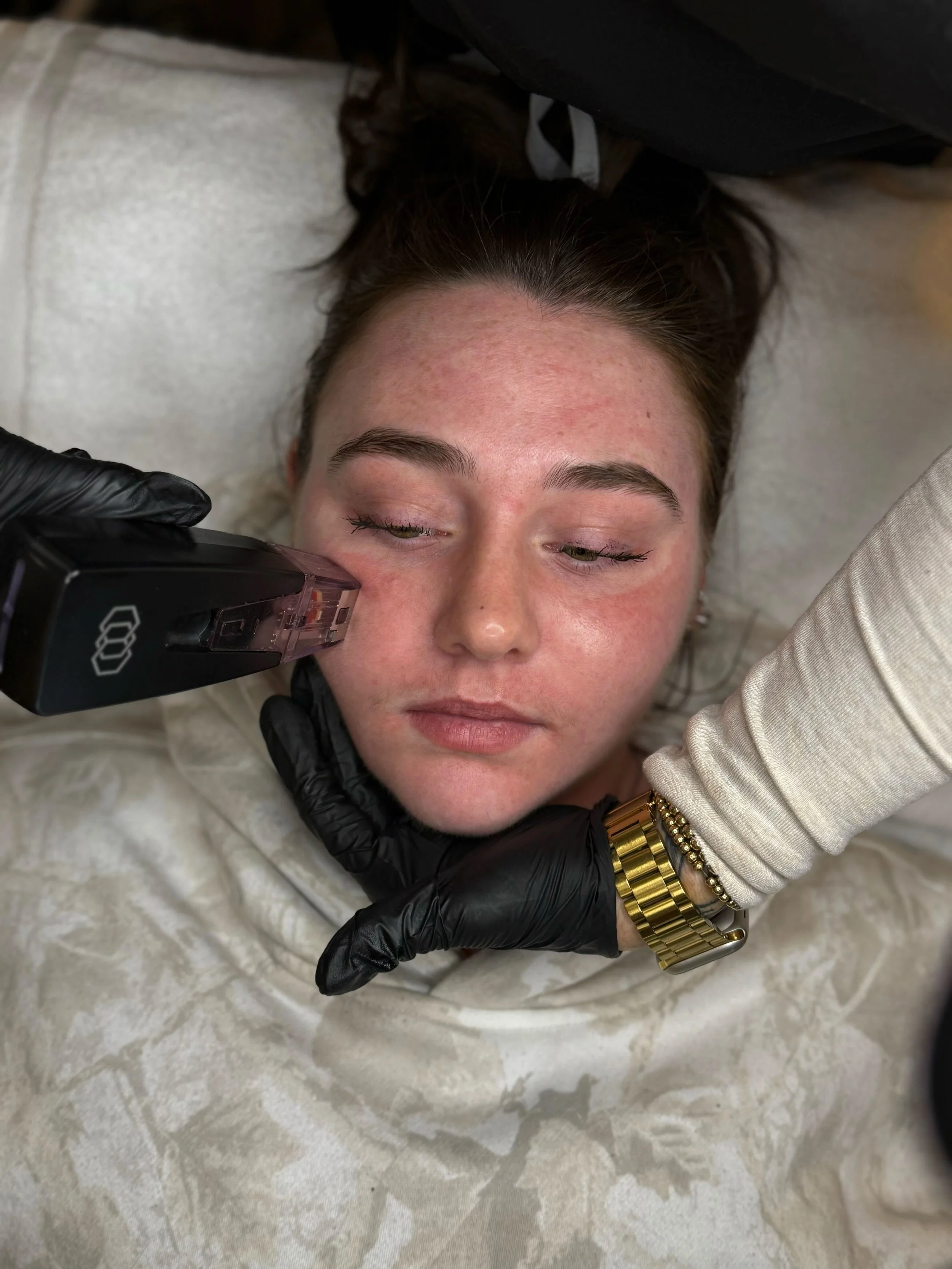 Collagen vs. Elastin: How RF Microneedling Rebuilds Your Skin's Foundation